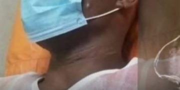 Hombre se clava clavo en la cabeza porque su cerebro estaba flojo